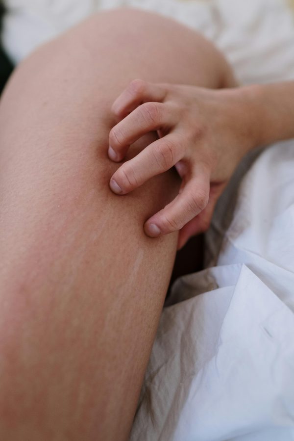 Tout ce que vous devez savoir sur la piqûre de puce